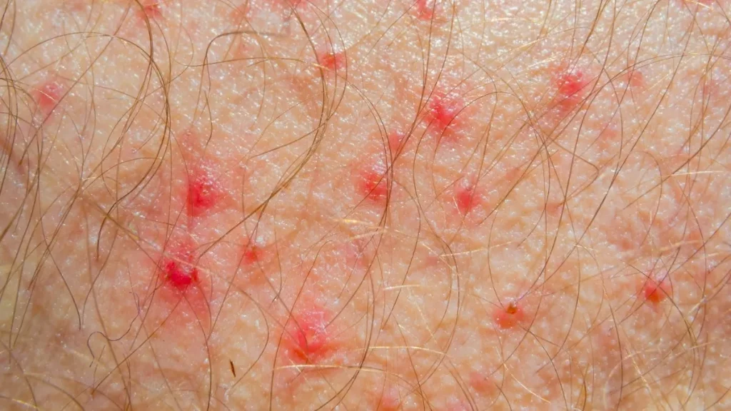 Mengenal Psoriasis